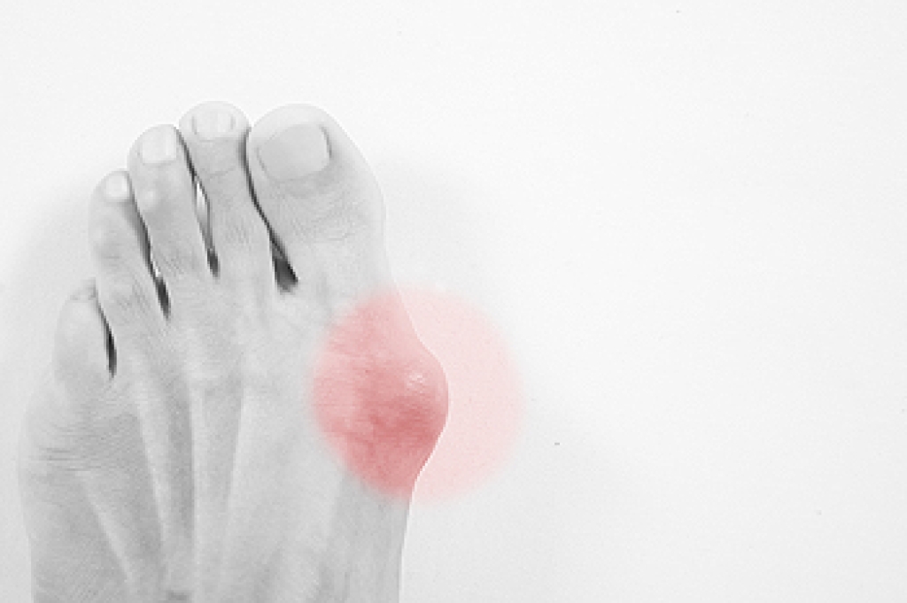Important Facts About Bunions
