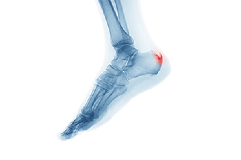 Understanding the Plantar Calcaneal Spur