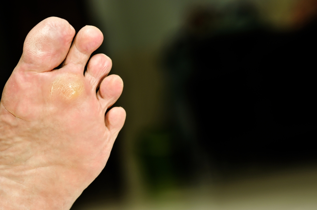 Plantar Warts and Podiatric Treatment