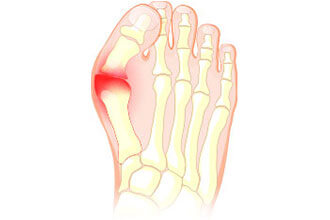 Bunion problem in the Palm Beach County, FL: Boynton Beach (Greenacres, Boca Del Mar, Lantana, Kings Point) and Wellington (Royal Palm Beach, Riviera Beach, Loxahatchee, Westgate) areas