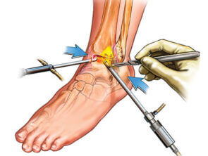 Ankle Arthroscopy