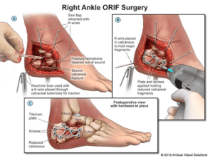 Calcaneal Fracture