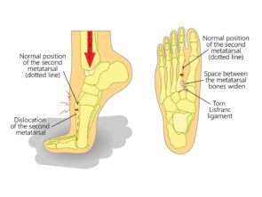 Lisfranc Injury