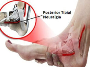 Posterior tibial neuralgia foot