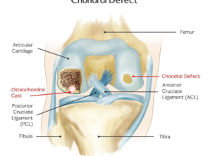 chondral defect