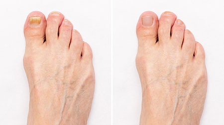Fungal toenails, toenail fungus diagnosis and treatment in the Palm Beach County, FL: Boynton Beach (Greenacres, Boca Del Mar, Lantana, Kings Point) and Wellington (Royal Palm Beach, Riviera Beach, Loxahatchee, Westgate) areas