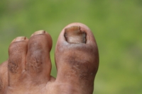 Recognizing Symptoms of Fungal Toenails