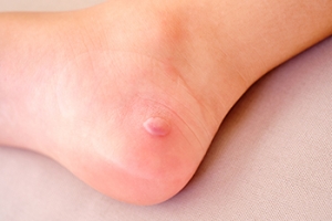 Types of Blisters on the Feet