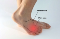 Morton’s Neuroma and Its Causes