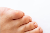 Causes of Foot Corns and Relief Tips