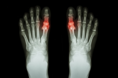 Understanding Painful Gout