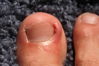 Mild and Severely Ingrown Toenails