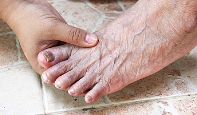 Causes and Symptoms of Toenail Fungus