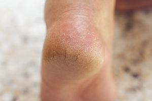 Heel Fissures